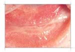 Symblepharon โ conjunctival adhesion