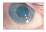 Symblepharon โ surgical lysis